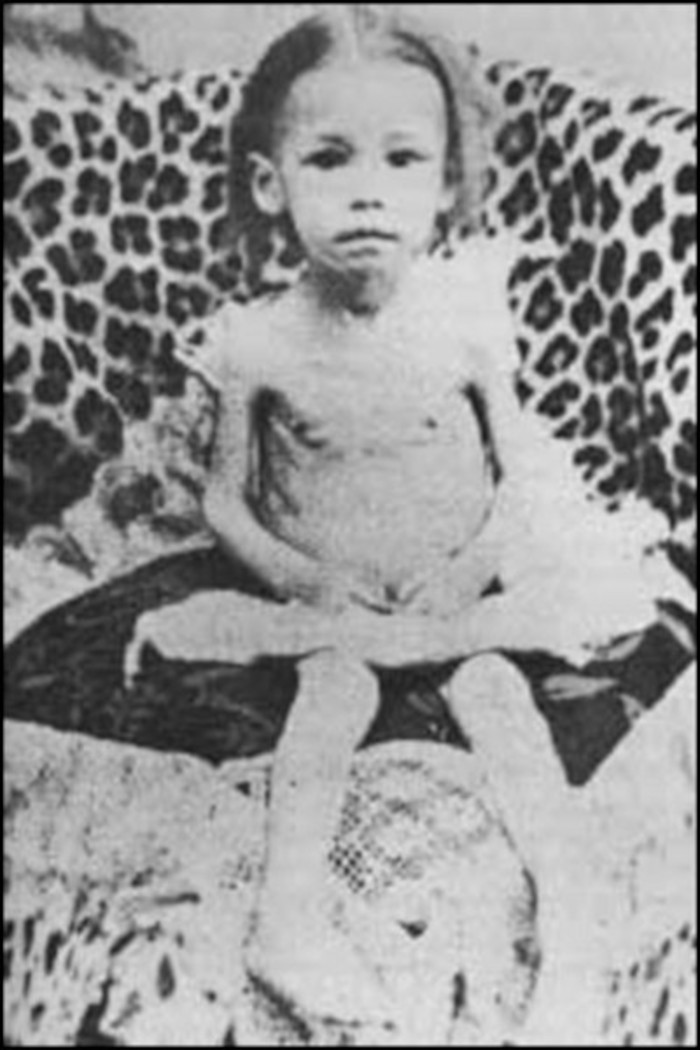 Boer child starvation.