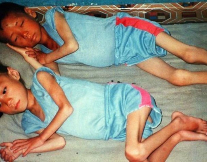 Famished Children of North Korea